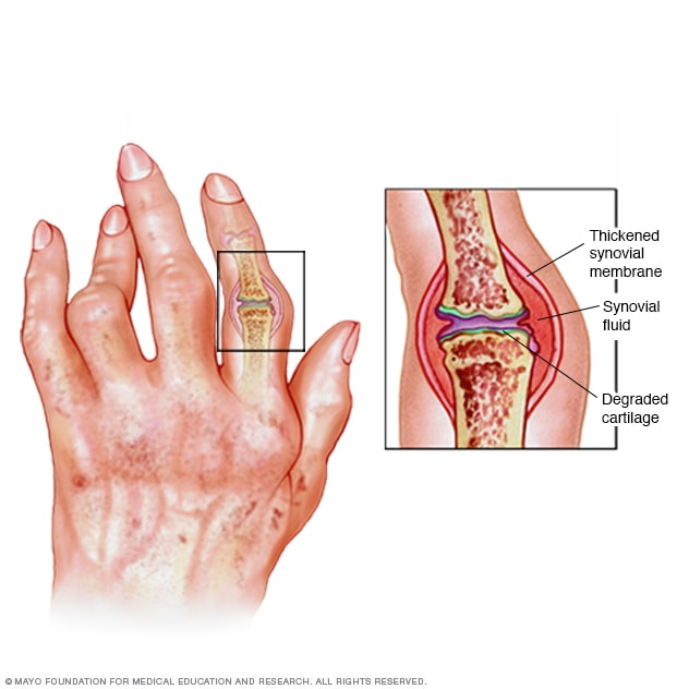 reumatoidinis artritas viki artrozė riešo ir jos gydymą