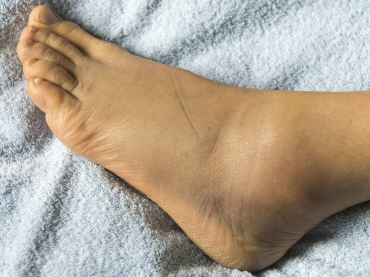 swelling in feet joints tepalas degeneracinių disko ligos gydymui
