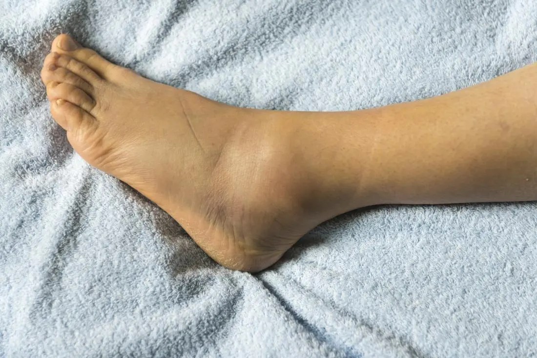swelling in feet joints rankų lenkimo skauda alkūnės sąnario