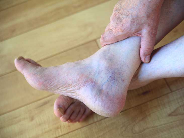 artritas rankos gydymas kremas laikykite gydymo pirštais namuose sąnarius