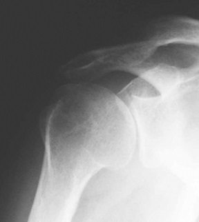 trauminio artrozė peties sąnario bursitas iš alkūnės sąnario ir jo gydymas