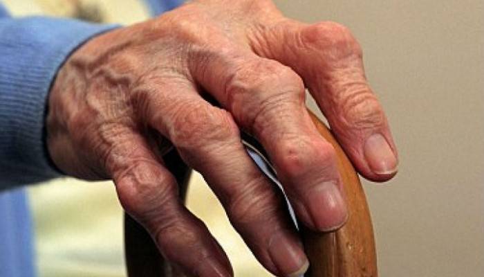 liaudies gynimo priemonės nuo artrito šepetys rankas sustaines skauda oras