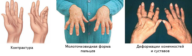 rankų bendra ligos gydymui tepalai prieš sąnarių skausmas