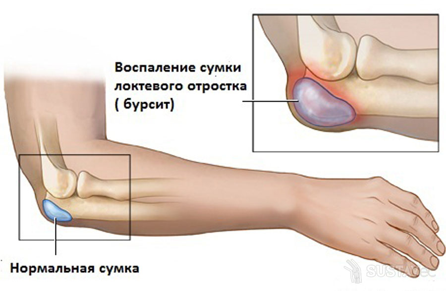 ureaplasm moterimis ir ligų sąnariai skausmas iš piršto sąnario lenkimo metu