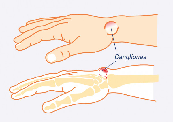 gydymas artrozės darbo liaudies gynimo rankas gali būti taikoma ar osteoartrito gydymui