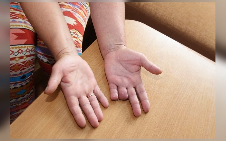 gydymas traumų pirštų sąnarių rankų gydymo kapsulės chondroitin ir gliukozaminas