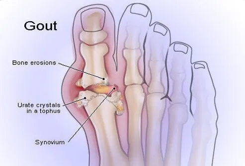 podagra arthritis mazi už osteoartrozės sąnarių gydymo