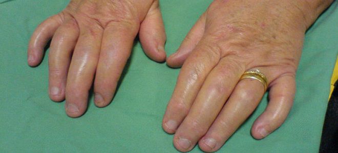 artrito gydymui spurgų ant rankų
