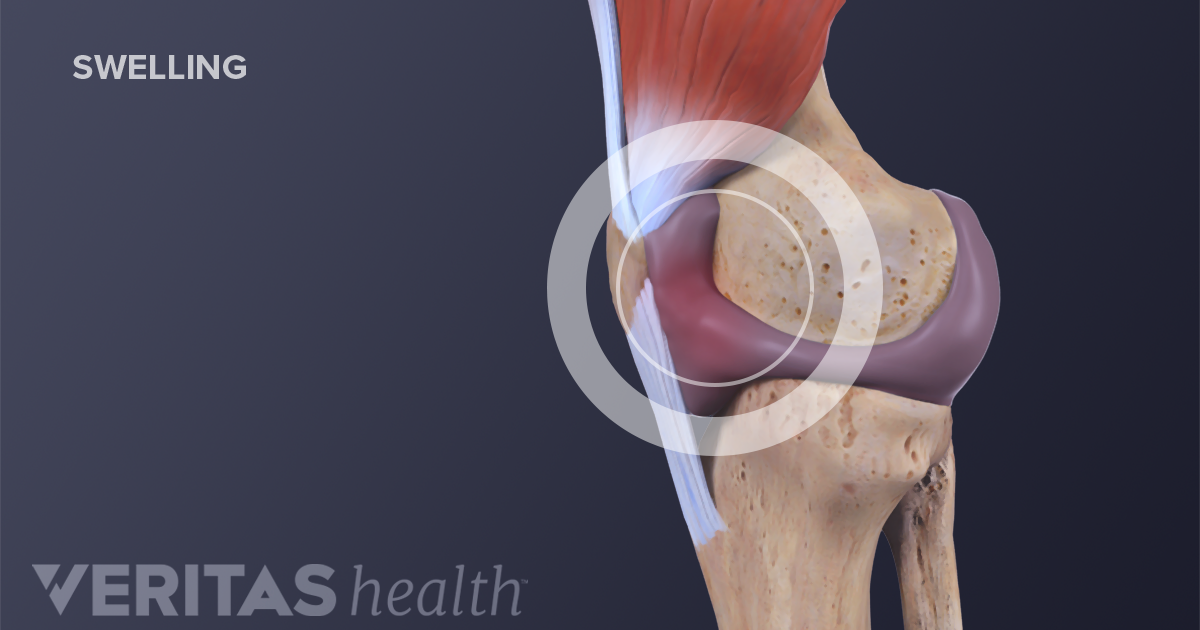 joint swelling is called sunaikinimą peties sąnario judesių gydymo