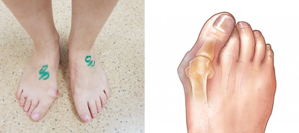 gydymas pėdos pėdos kaip pašalinti skausmą artritu peties sąnario