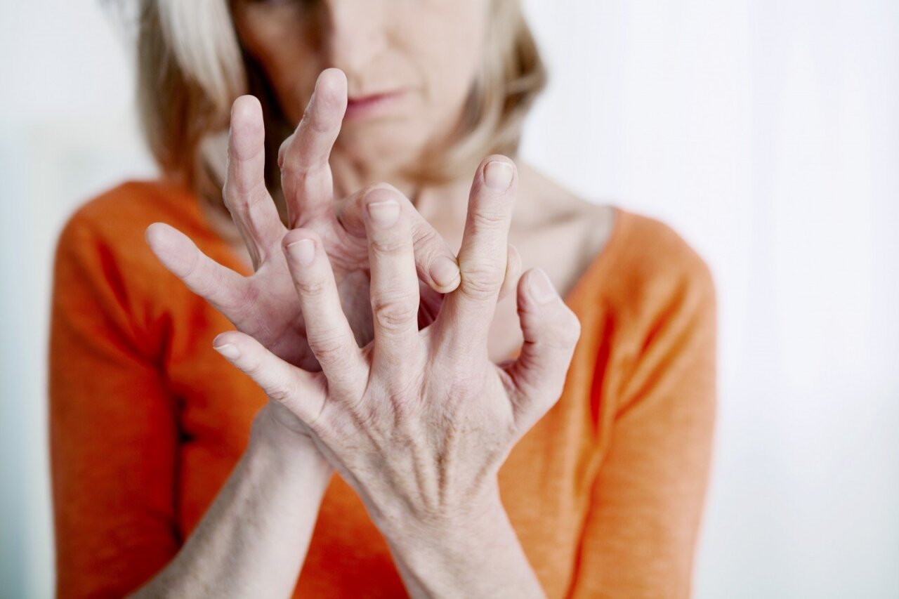 rankų artritas edema netoli sustava