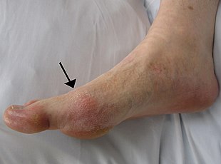 podagra arthritis artritas kodas pečių palaikimo