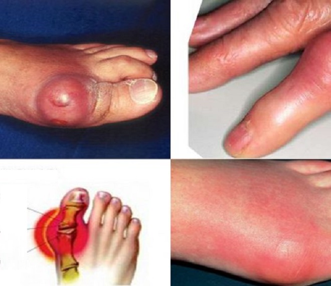 podagra forumas uždegimas alkūnės sąnario artritas