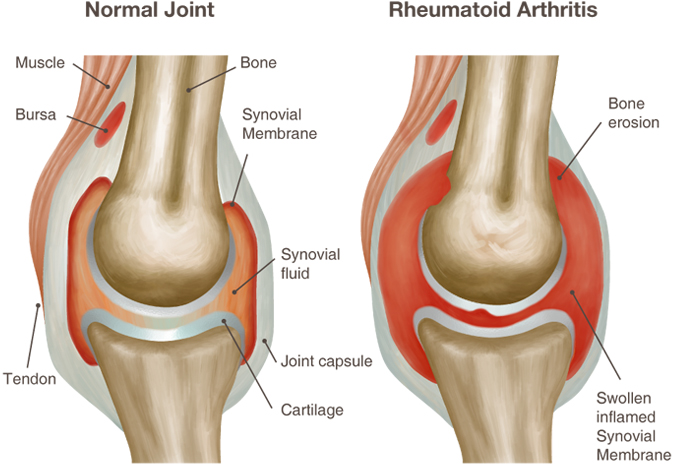 reumatoidinis artritas pečių palaikimo