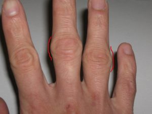 artritas bendros šepečiai rankos