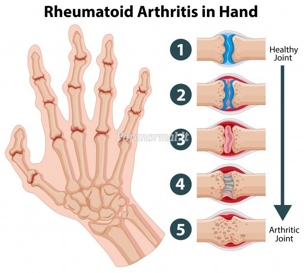 perkrautas bendra artritas artroze un invaliditate