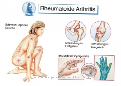 kaip veikia sąnarių skausmas swollen painful joints not arthritis