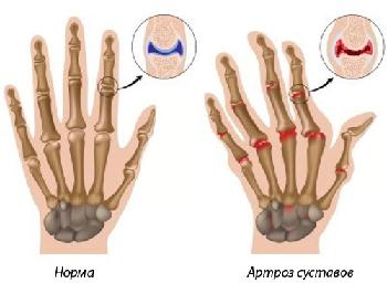 nacionalinės gydymo metodai artrozės edema and painful joints
