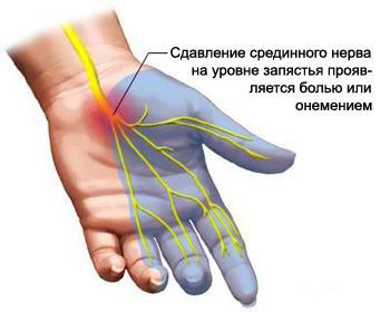 tempimo alkūnės sąnarių rankų gydymui raumenis kvarco ir sąnarių ligos