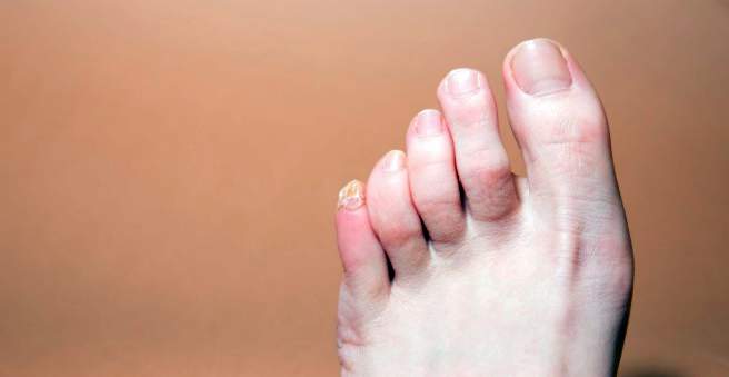 artritas iš pėdos pirštų ką daryti jei skauda alkūnės