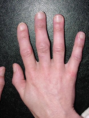 artritas pirštų ant rankų