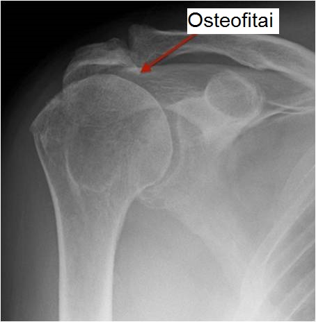 artrozė peties išlaikyti su gydymas osteoartrito 2-ojo laipsnio