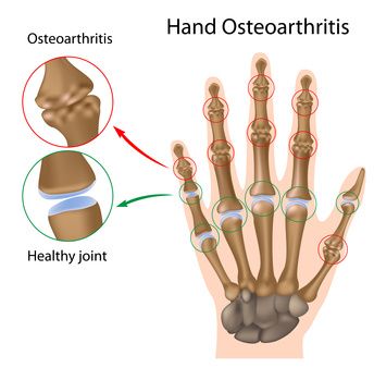 osteoartrito iš midfoot sąnarių