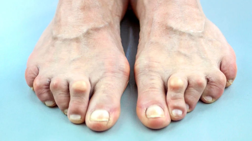swelling in feet joints prieš uždegimą sąnariuose