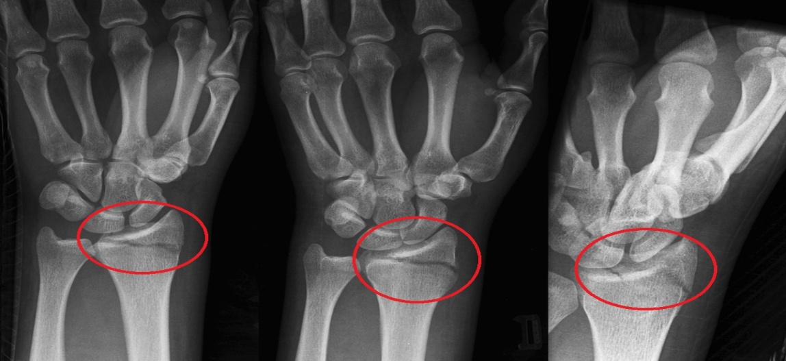 gydymas sąnarių rankų laktacijos metu atsilenkimai sandūrą pirštu ant rankų gydymui