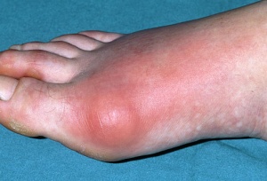 podagra arthritis kaina gliukozamino chondroitino