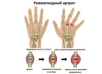 ženklai artrozės nuo šepetėliai rankų sąnarių