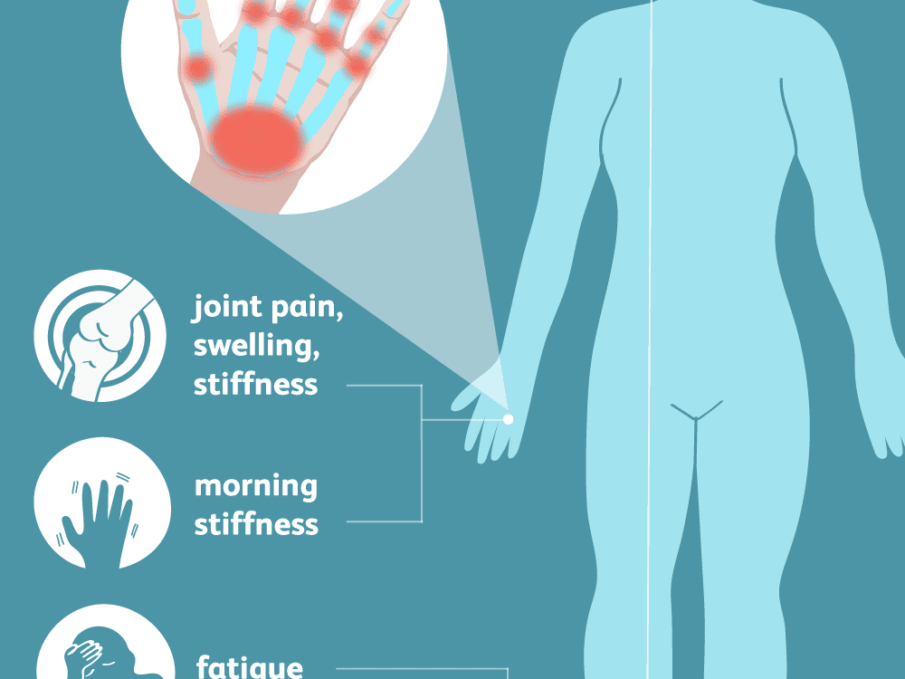 artrozė peties sustav mazi
