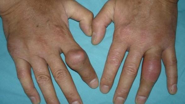 artrito gydymui spurgų ant rankų