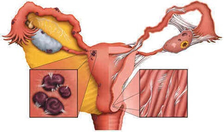 endometriozė sąnarių skausmas