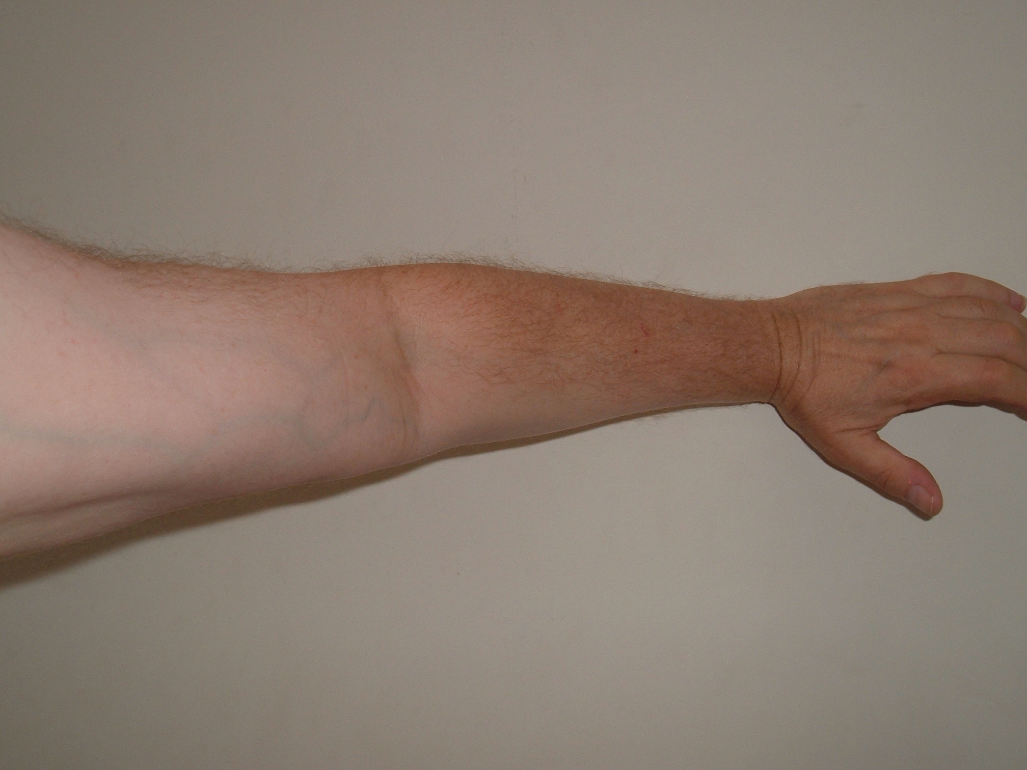 kad trigerius artrito rankas skausmas alkūnės sąnario kai lankstant ir pratęsimas