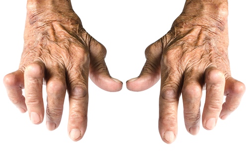 kas yra traktuojami artritas