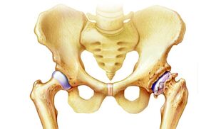pirmieji požymiai artritu pirštais jei sąnarys skauda ant viduriniojo piršto