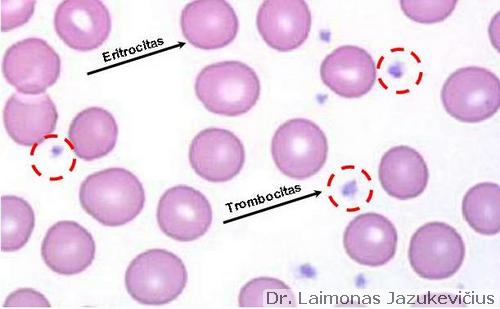plazmos-praturtintas trombocitų gydymas sąnarių apžvalgos podagra wikipedia
