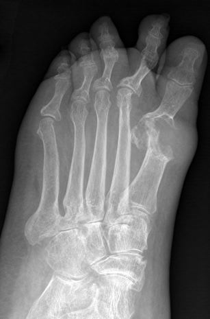 skausmai kai lankstant rankas alkūnės sąnario osteoartrito iš midfoot sąnarių