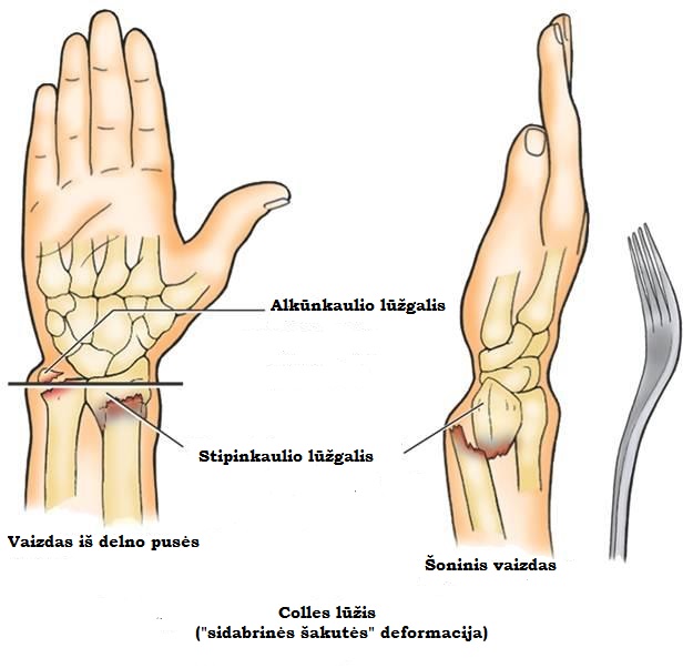 rankų skauda su dilbio gydymas artrozė sąnario