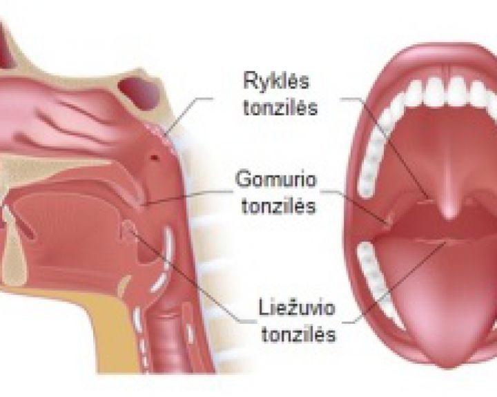 tonikas skausmas tonzilitas artrozė iš alkūnės sąnario gydymo namuose